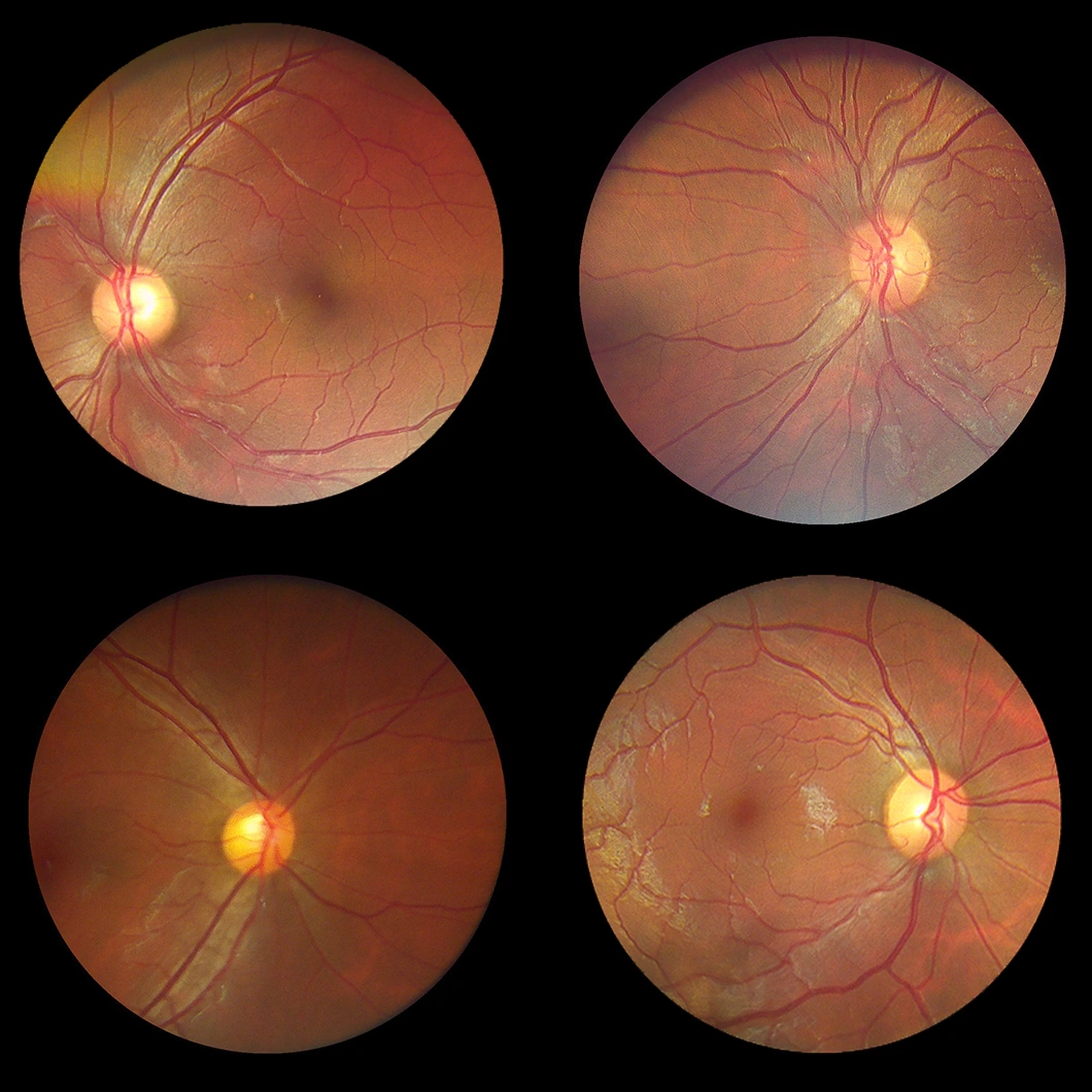 Hes-1000 Portable Handheld Non-Mydriatic Digital Fundus Retinal Camera